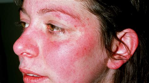 Lupus Flare Up Skin Arch Instead For Lupus Flare Up Douroubi