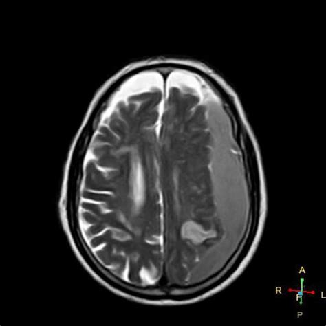Acute Subdural Haematoma And Cerebral Infarction Radiology Case