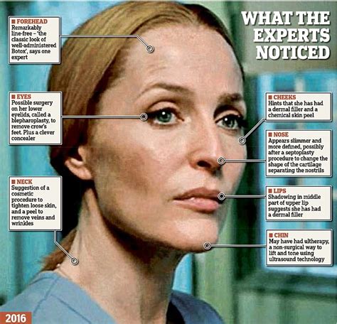 Ageless Gillian Anderson And The Anti Wrinkle Injections Files Lma Clinic