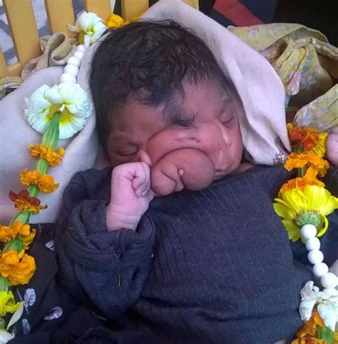 Baby Girl Born With Trunk Hailed As Indian God Herie