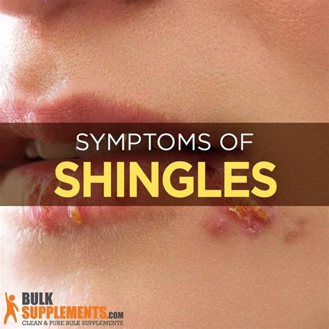 Shingles Symptoms Diagram