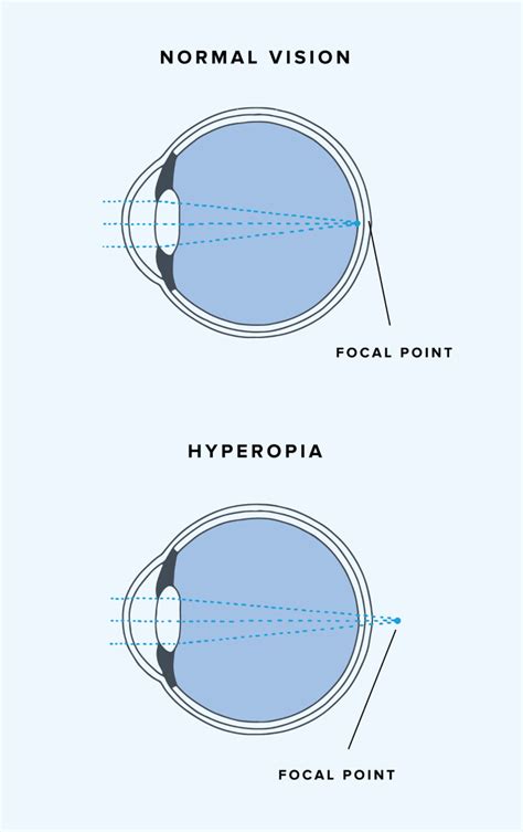 What Is Farsightedness Hyperopia Warby Parker