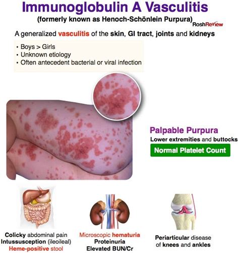 Immunoglobulin A Vasculitis Pediatric Medicine Medical Mnemonics