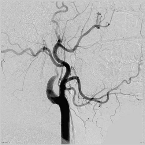 Internal Carotid Artery Dissection Image Radiopaedia Org
