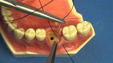 Surgical Technique Figure Of Eight Close Vertical Dental And Medical