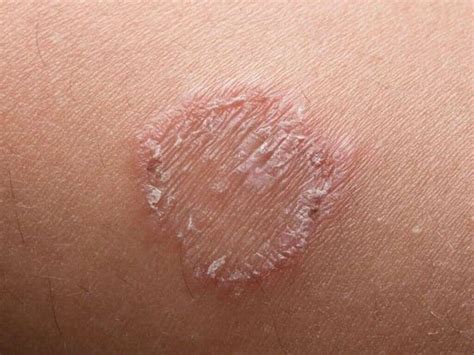 Ringworm Pictures Causes And Symptoms How Does It Look Like Images