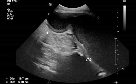 Missed Diagnosis Of Imperforate Hymen Later Presenting With