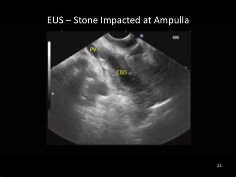 Approach To Common Bile Duct Stones