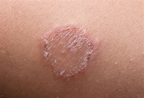 Ringworm In Infants Reasons Signs And Remedies
