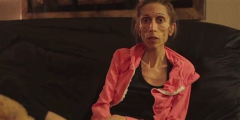 Woman Dying From Anorexia Speaks Out About Her Battle With The Illness