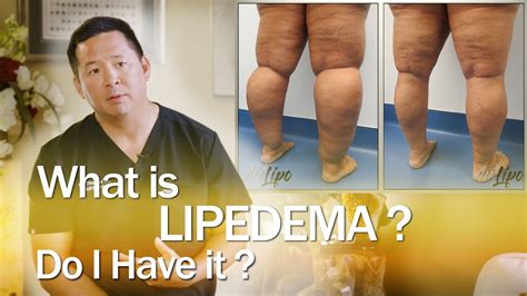 Lipedema Surgery Liposuction Expert Dr Thomas Su Artlipo Youtube