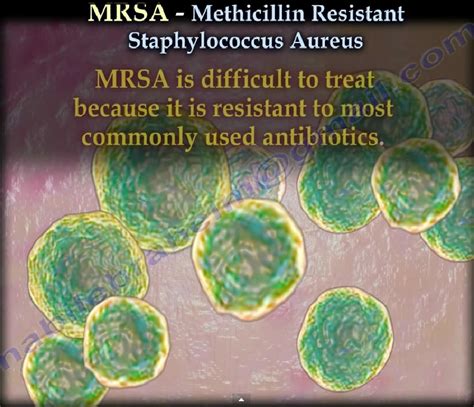 Methicillin Resistant Staphylococcus Aureusmrsa