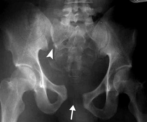 Pelvic Fractures Orthoinfo Aaos 2022