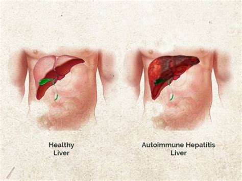 What Causes Autoimmune Hepatitis 60secondsnow