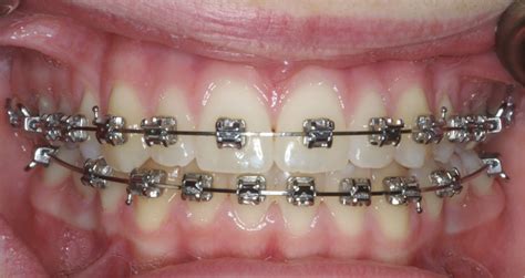 Houston's advance orthodontics offers quality orthodontic care, braces, invisalign and more to at advance orthodontics, we are dedicated to providing you with an orthodontic experience that is. Orthodontic Appliances Bunbury - South West Orthodontics