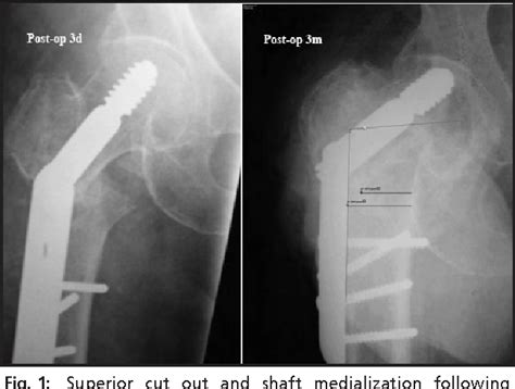 Figure 1 From Dynamic Hip Screw Compared To Condylar Blade Plate In The