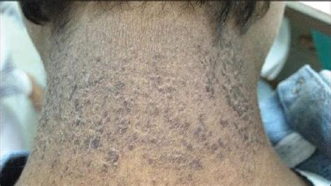 Causes Of Dermatitis Neglecta Pictures And Treatment