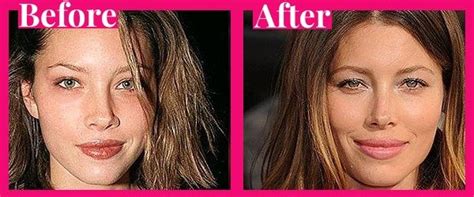 Jessica Biel Rhinoplasty Nose Jobs Nose Job Plastic Surgery