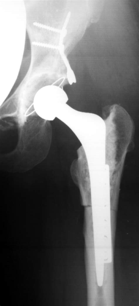 Treatment Of Crowe Iv High Hip Dysplasia With Total Hip Replacement