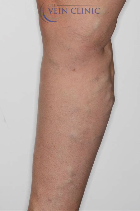 Varicose Veins Before And After Pictures Vein Clinic Perth