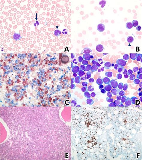 Peripheral Blood And Bone Marrow Findings In Patients With Chronic