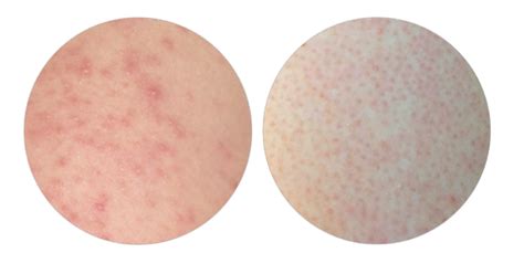 The Keratosis Pilaris Aka Chicken Skin Fixes Youve Been Waiting For