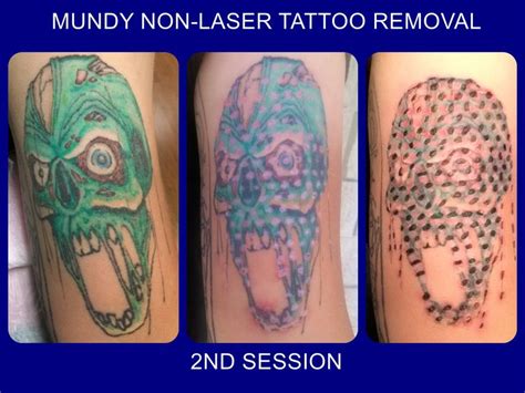 At our clinic in the greater philadelphia, pa area, we will cover these questions and more. 2nd session done on zombie head.... tatt2away removal ...