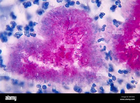 Nocardia Brasiliensis Bacteria Hi Res Stock Photography And Images Alamy