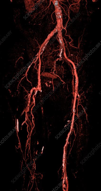 Abdominal Aorta Calcification Ct Angiography Stock Image C039