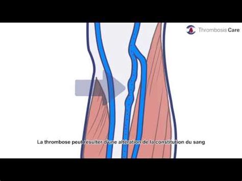 „die welt bietet ihnen nützliche infos über symptome, diagnose, ursachen und behandlungsmöglichkeiten von thrombosen. la thrombose veineuse profonde - YouTube