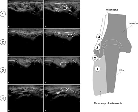 Ultrasonographic Appearance Of Ulnar Nerve At Different Points Of Elbow