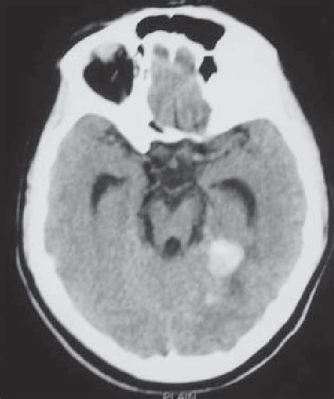 Ct Scan Of The Brain Showing Diffuse Subarachnoid Hemorrhage And Foci