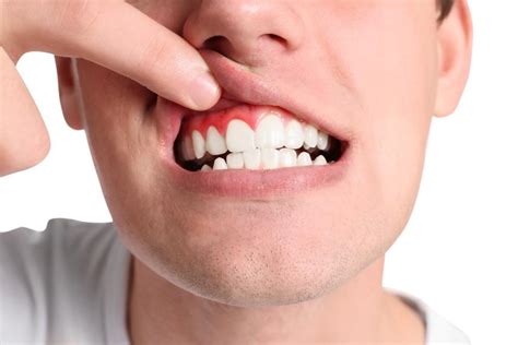Top Causes Of Gum Recession Tompkins Dental General Dentistry