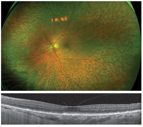 Retinal Imaging See More Than Ever Before