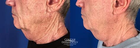 Profound Before And After Results Contour Dermatology