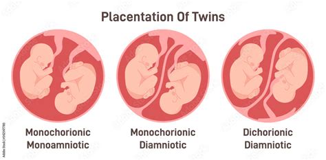 Twin Types Monozygotic Or Dizygotic Placentation Of Twins