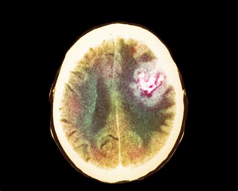 Astrocytoma Brain Cancer Growth Ct Scan Photograph By