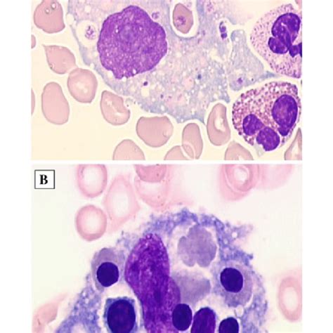 Diagnostic Criteria For Hemophagocytic Lymphohistiocytosis Hlh As