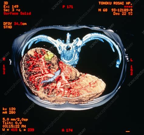 Coloured Ct Scan Of Human Abdomen Showing Liver Stock Image P530