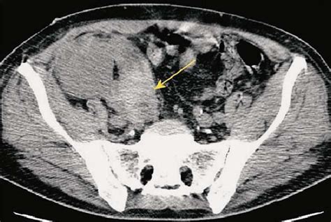 Unenhanced Ct Axial And Sagittal View A Large Perirenal Hematoma