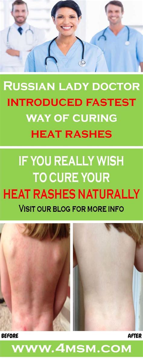 How To Get Rid Of Heat Rash Naturally Heat Rash How To Get Rid Skin