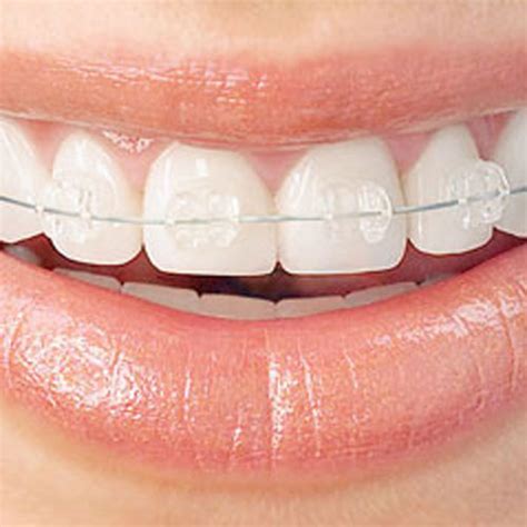 Wilkinson Orthodontics Trusted Gold Coast Orthodontists Invisalign