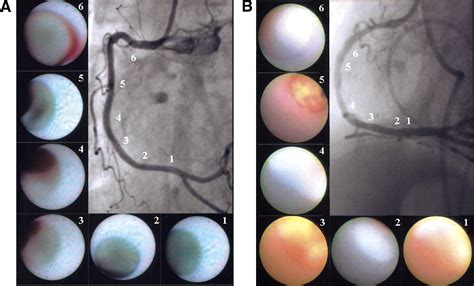 Number Of Yellow Plaques Detected In A Coronary Artery Is Associated