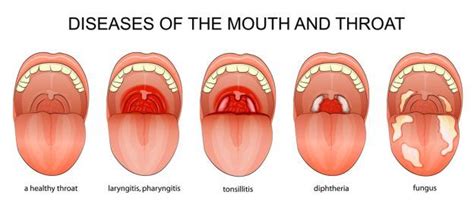 Sore Throat Types Causes Symptoms And Treatments