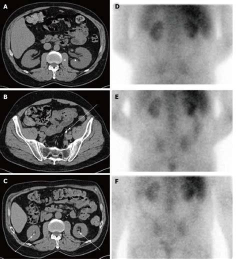 Sequential Imaging Studies Of A Not Yet Reported Patient With Chronic