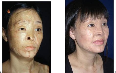 Principles Of Burn Reconstruction Grabb And Smiths Plastic Surgery