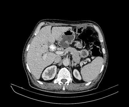 Mirizzi Syndrome Radiology Reference Article Radiopaedia Org