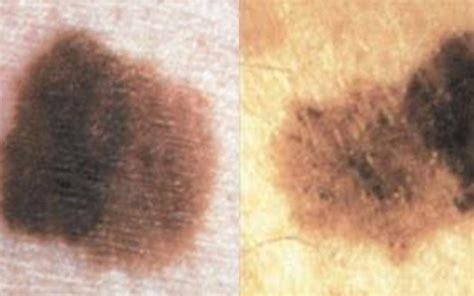 Whats The Difference Between Melasma Sun Spots And Other Skin Spots