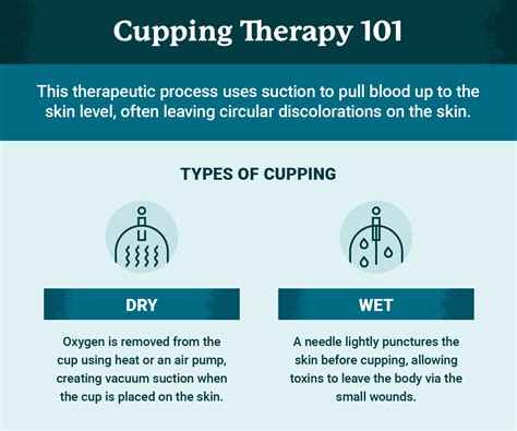 What Is Cupping Therapy? Benefits and Applications | USAHS