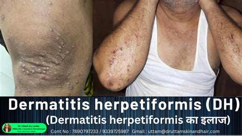 Dermatitis Herpetiformis Dh का इलाज Itching Water Filled Rashes On